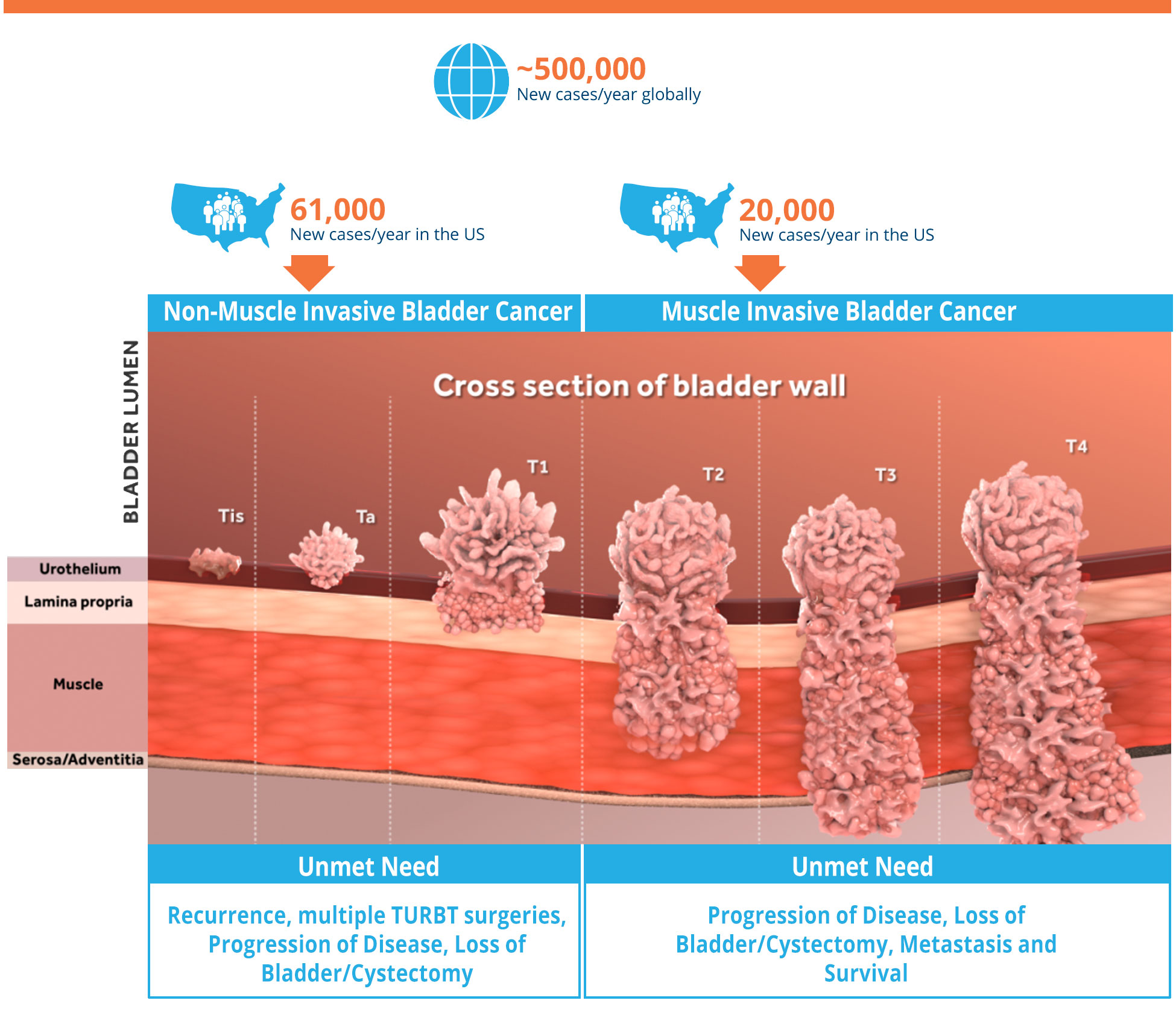 Market opportunity - Non-muscle invasive and muscle invasive bladder cancers